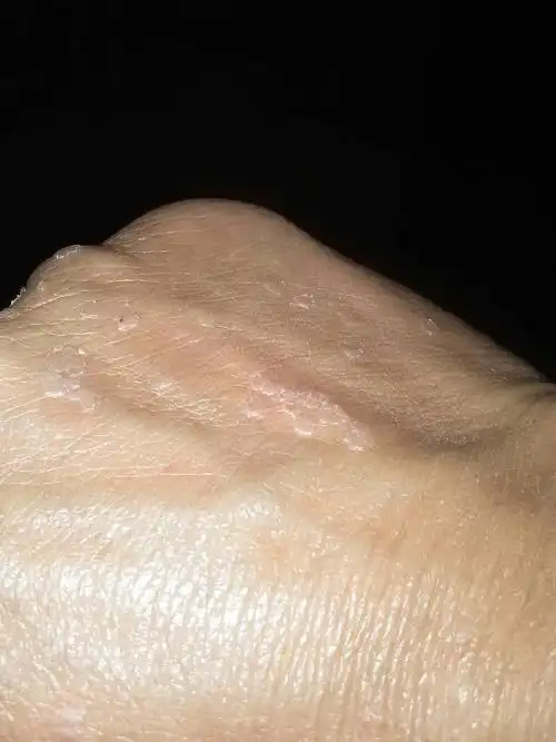 问:手背上的扁平疣怎治?