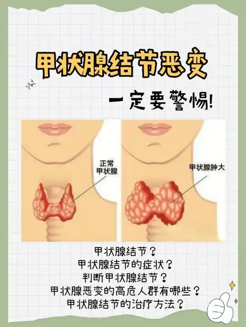 72甲状腺结节恶变一定要警惕