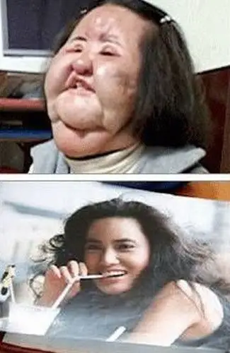 韩国女明星整容失败后遗症让人惊叹