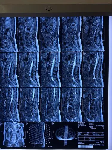 赤峰学院附属医院首例经椎板间隙入路经皮内镜下腰椎间