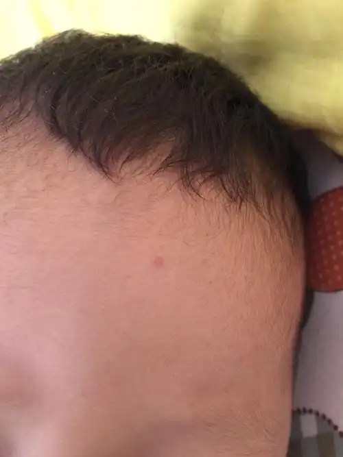 宝宝脸上长的是传染性软疣吗时而发红长大时而不红消褪这样反反复复快