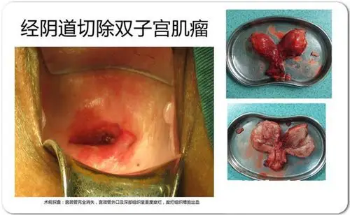 经阴道切除双子宫肌瘤图片