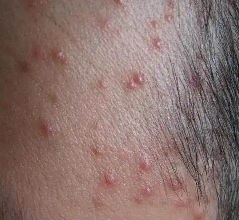 高危行为后,皮肤长痘痘,不是艾滋病是什么?