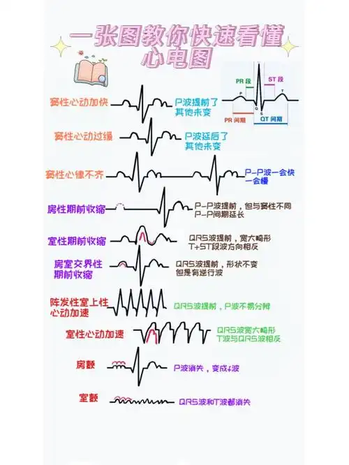 心电图导联怎么看懂心电图