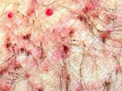 龟头包皮炎是龟头与包皮的弥漫性炎症.