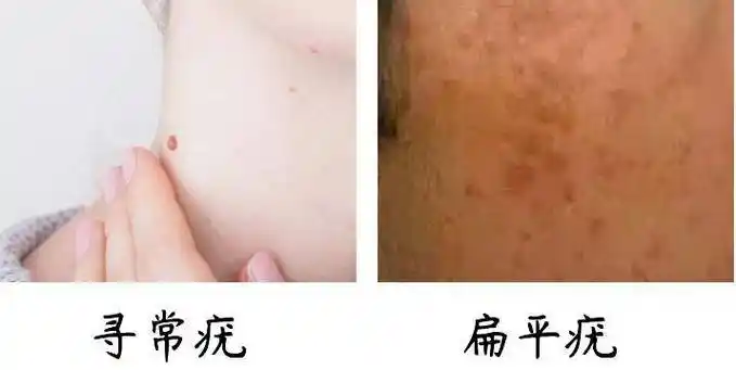疣是由人类乳头瘤病毒(hpv)感染皮肤黏膜引发的一种皮肤良性增生性
