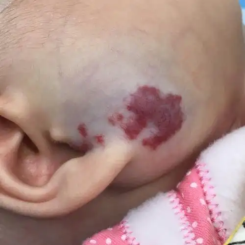 婴幼儿身上起红点除了蚊虫叮咬还可能是血管瘤