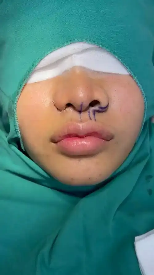 鼻翼缩小#鼻翼肥大造成的鼻孔外漏等情况可以通过鼻翼缩小来解决.