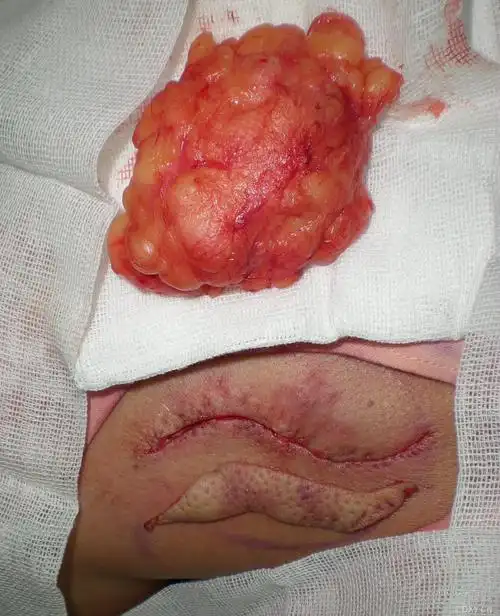 【 资源】背部脂肪瘤切除—真皮瓣填充