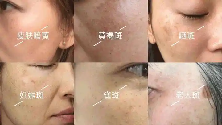 u牌护肤小知识:怎么鉴别脸上长的什么斑