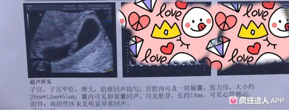 这个孕囊是传说中的茄子型?