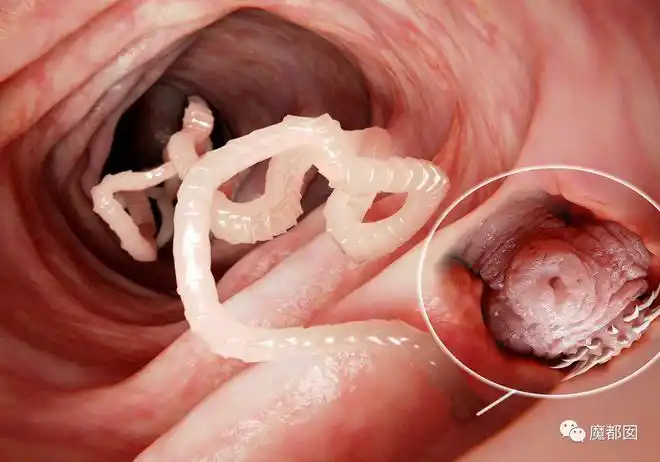 震撼女生体内排出495米绦虫你肠道里有东西蠕动吗