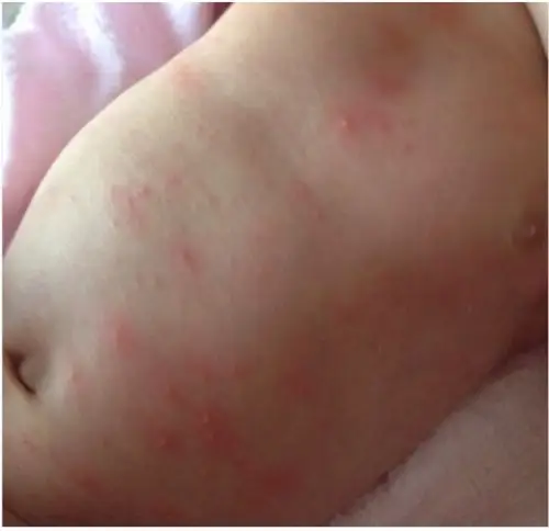 幼儿急疹疹子的图片