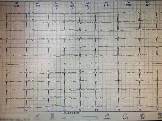 交界性逸搏? - 心电图脑电图专业讨论版 - 爱爱医医学论坛