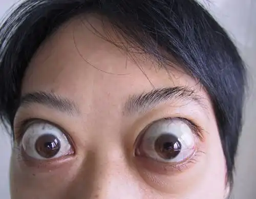 甲亢和甲状腺一样吗