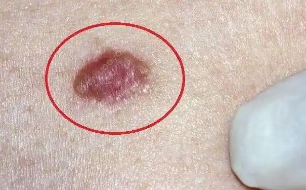 身上长这种红色的小疙瘩, 很有可能是癌症前兆!_网易订阅