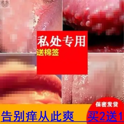 性病克星一扫光淋病梅毒龟头炎生殖男器疱疹断根私处药膏女防复发