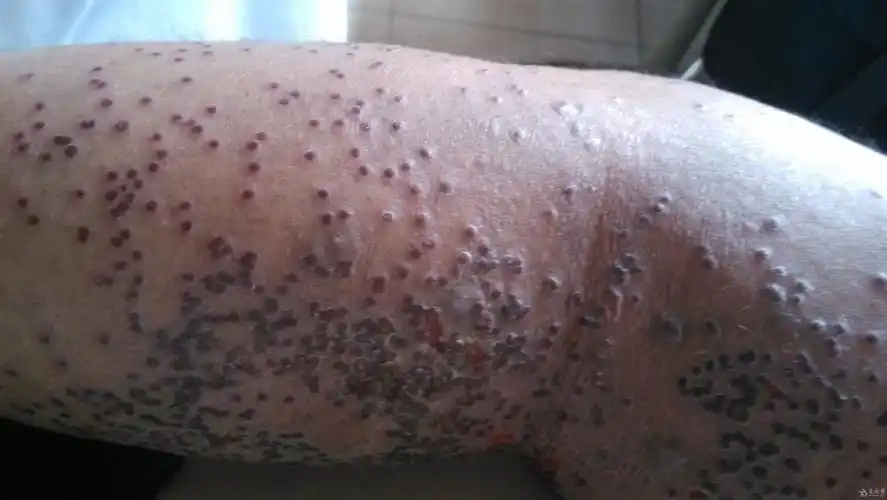 一老外 腿上严重的皮肤病 请教大家