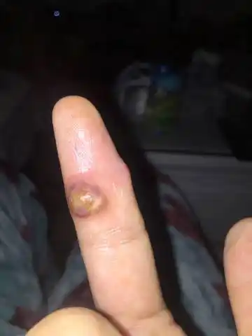 谁做过化脓性肉芽肿治疗?疼吗?