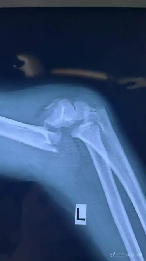 左侧肱骨髁上骨折一例