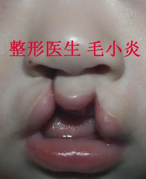 唇腭裂_唇腭裂治疗方式 - 好大夫在线