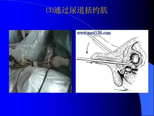 膀胱镜检查及护理ppt