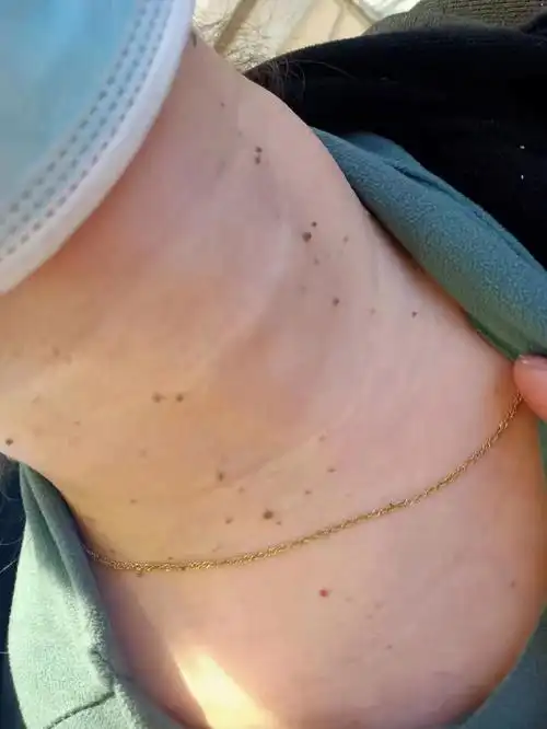 美丽的蜕变小瘊子不见了