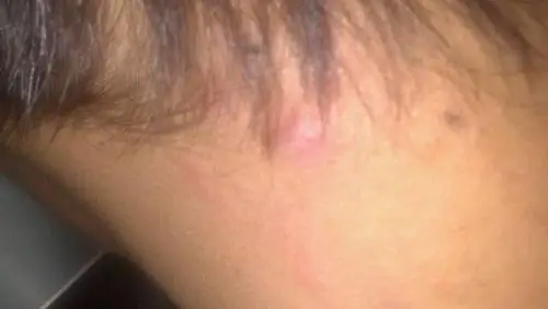 脖子后面起了好多疙瘩这是什么