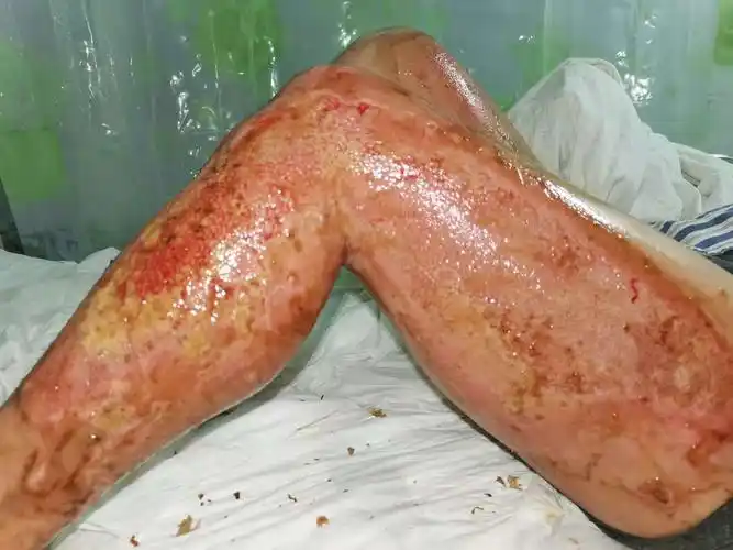 2020年烧伤疮疡在我科的发展