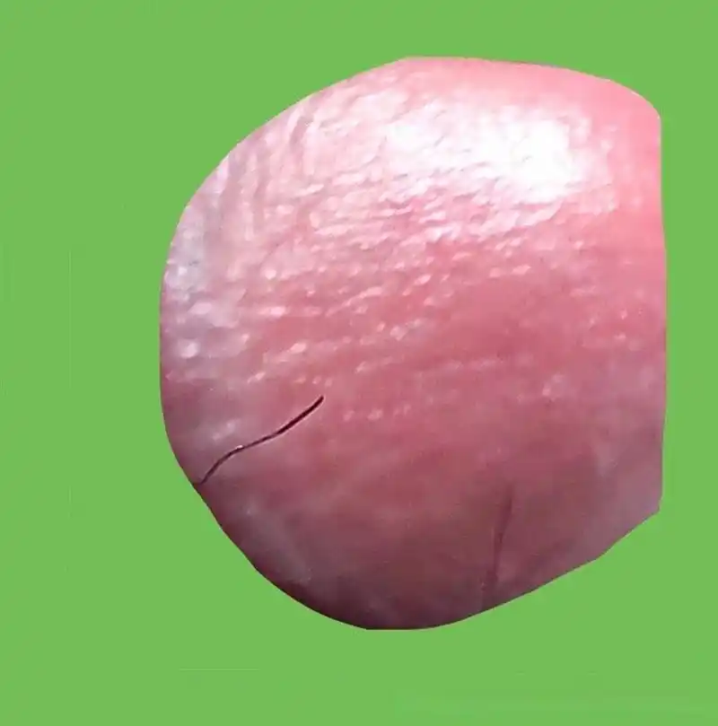 男32岁,大约4月中旬龟头上出现红点,尿道口容易发红不痛不痒,个把星期