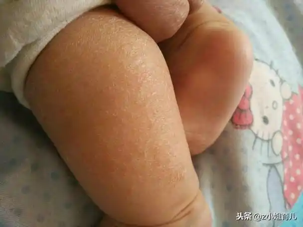 小孩脸上长好多鸡皮疙瘩怎么办