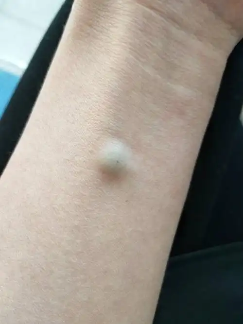 手臂上内侧出现一个包,有人知道这是怎么回事吗?需要去医院吗?