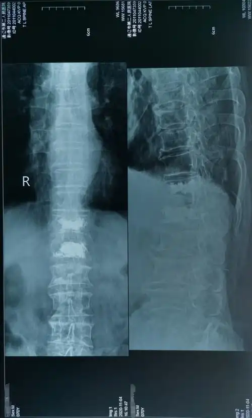70岁腰椎压缩性骨折患者椎体成型手术一例