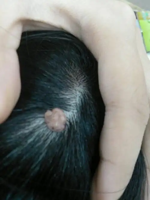 头顶长肉色隆起肉包,好像从小就有,曾经自己抠破过.