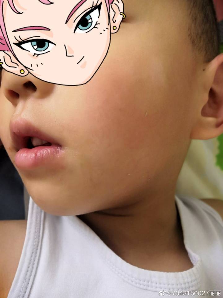 儿子腺样体肥大